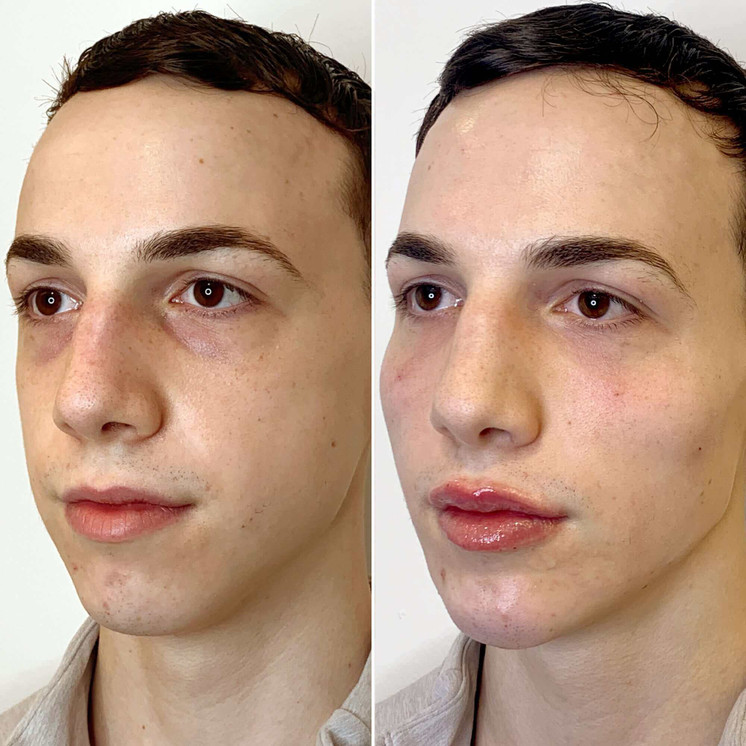 FaceFix: Face Lift for Men