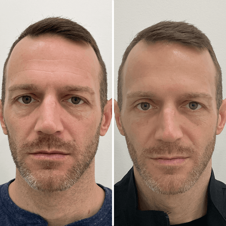 FaceFix: Face Lift for Men