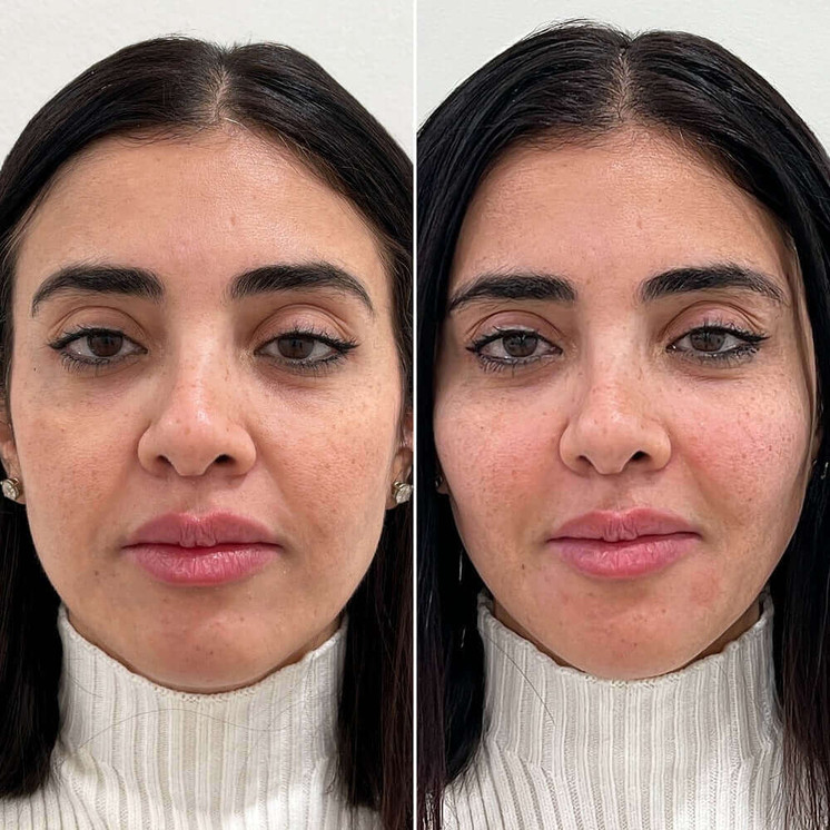 FaceFix: Sculptra