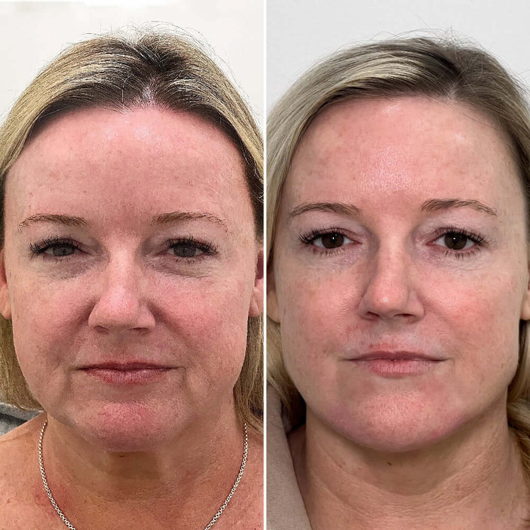 FaceFix: Sculptra