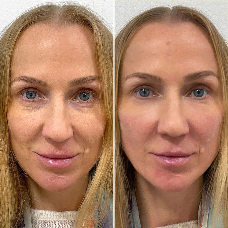 FaceFix: Sculptra