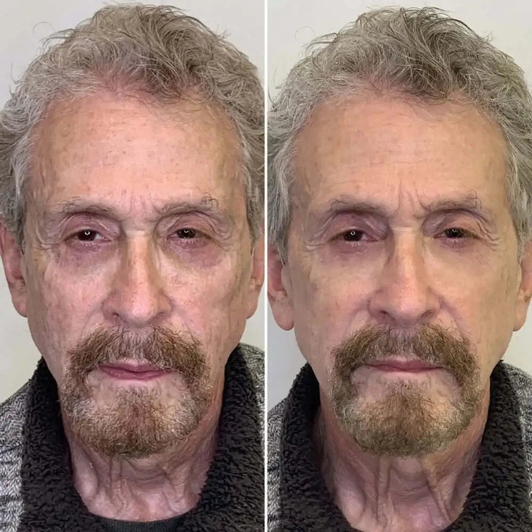FaceFix: Sculptra