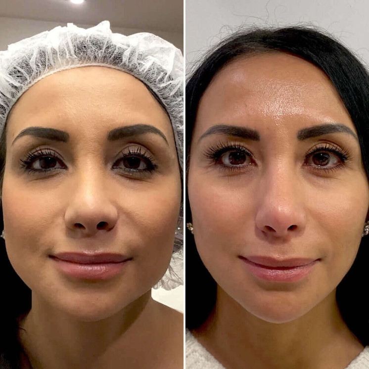 FaceFix: Sculptra