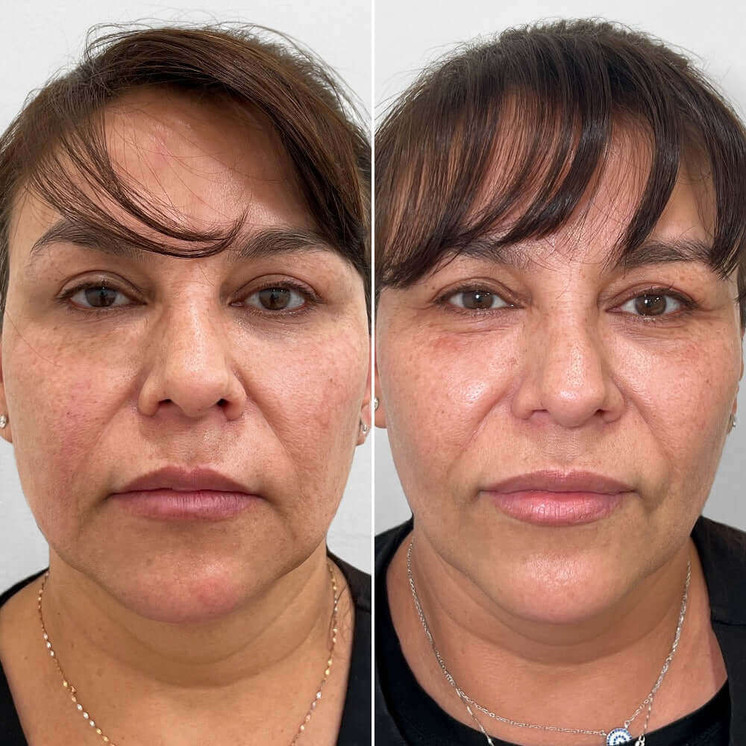 FaceFix: SkinVive