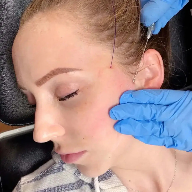 FaceFix: Thread Lift