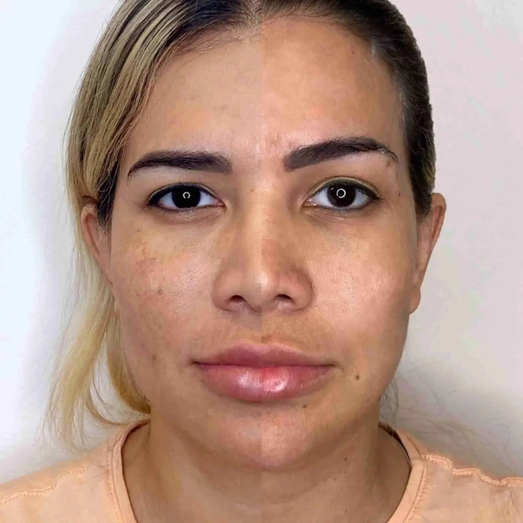 FaceFix: Thread Lift