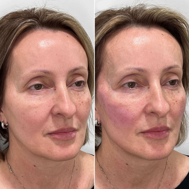 FaceFix: Thread Lift