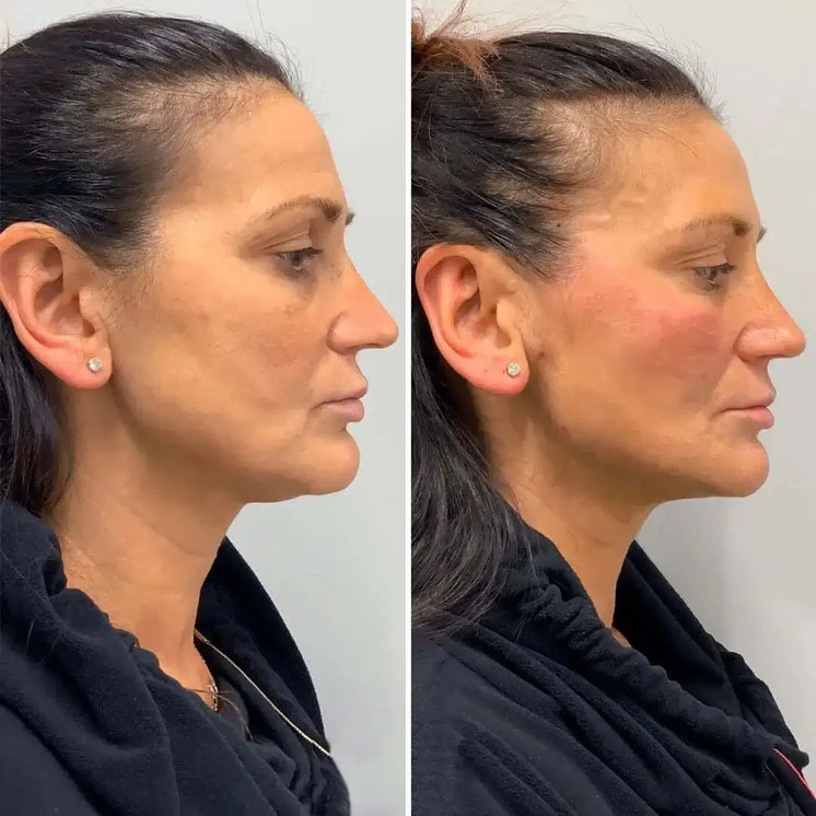 FaceFix: Thread Lift