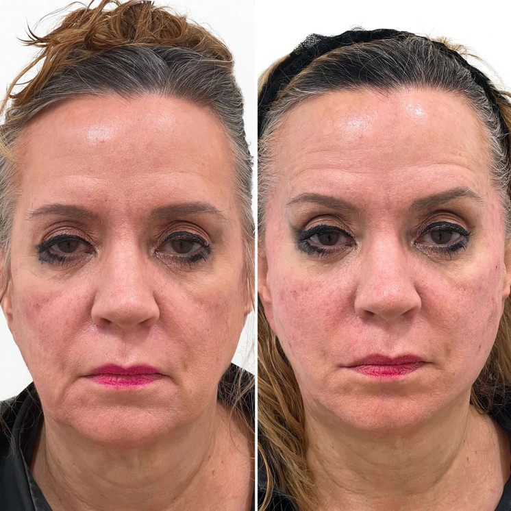 FaceFix: Thread Lift