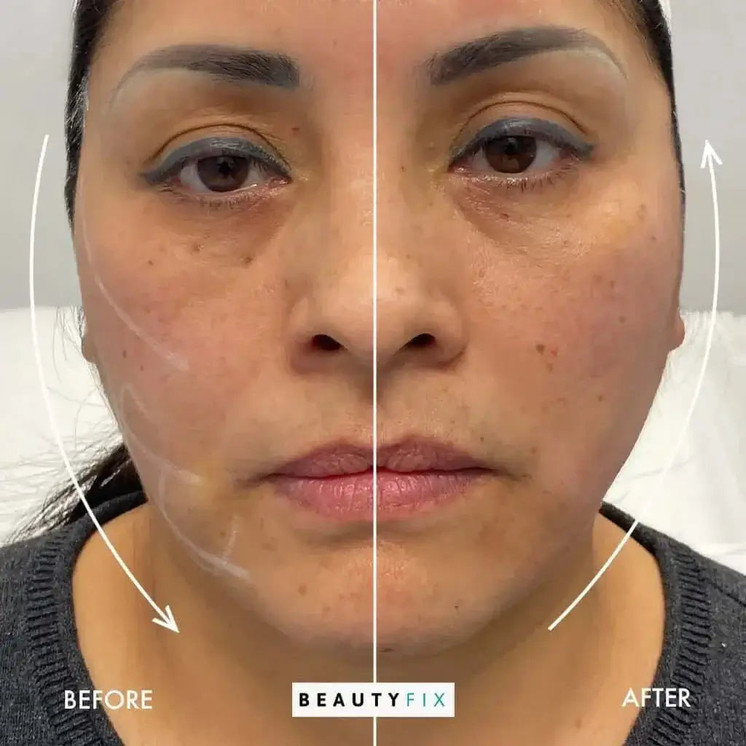FaceFix: Thread Lift