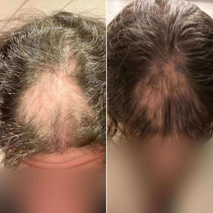 HairFix: Exosomes