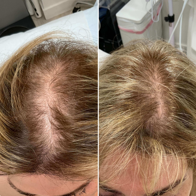 HairFix: Exosomes