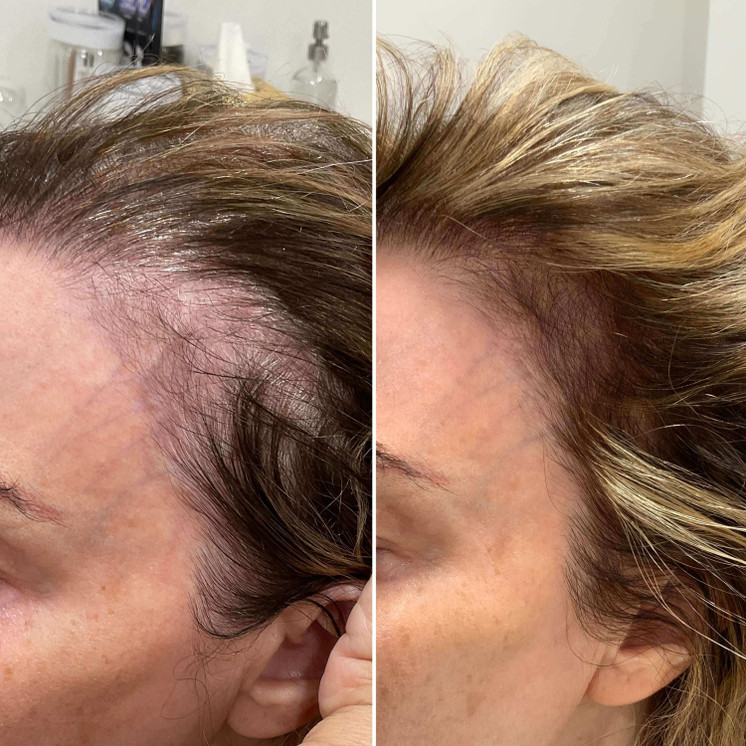HairFix: Exosomes