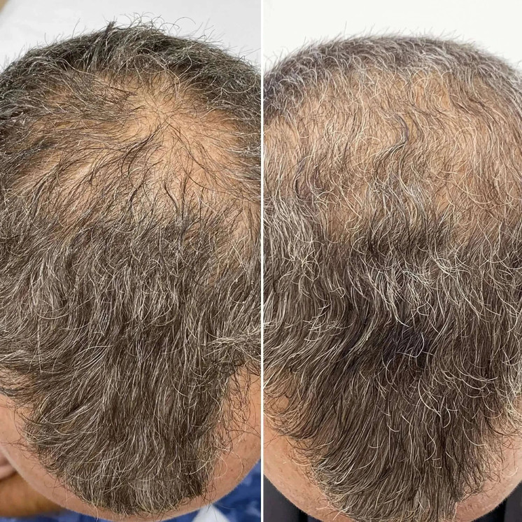 HairFix: Exosomes