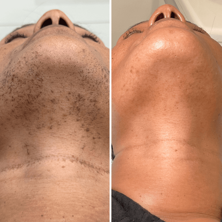 HairFix: Laser Hair Removal Small