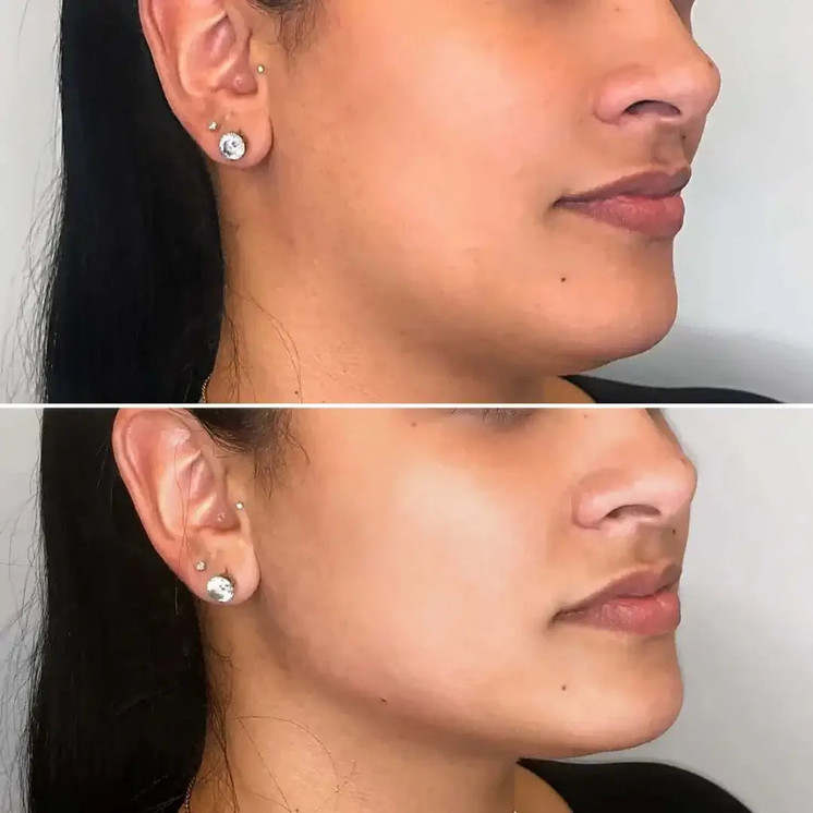 JawlineFix: Filler
