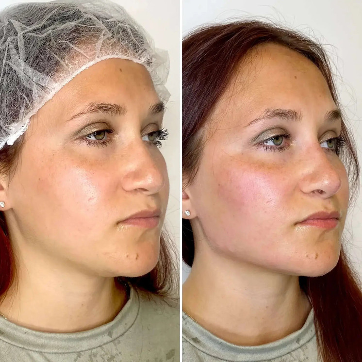 JawlineFix: Filler