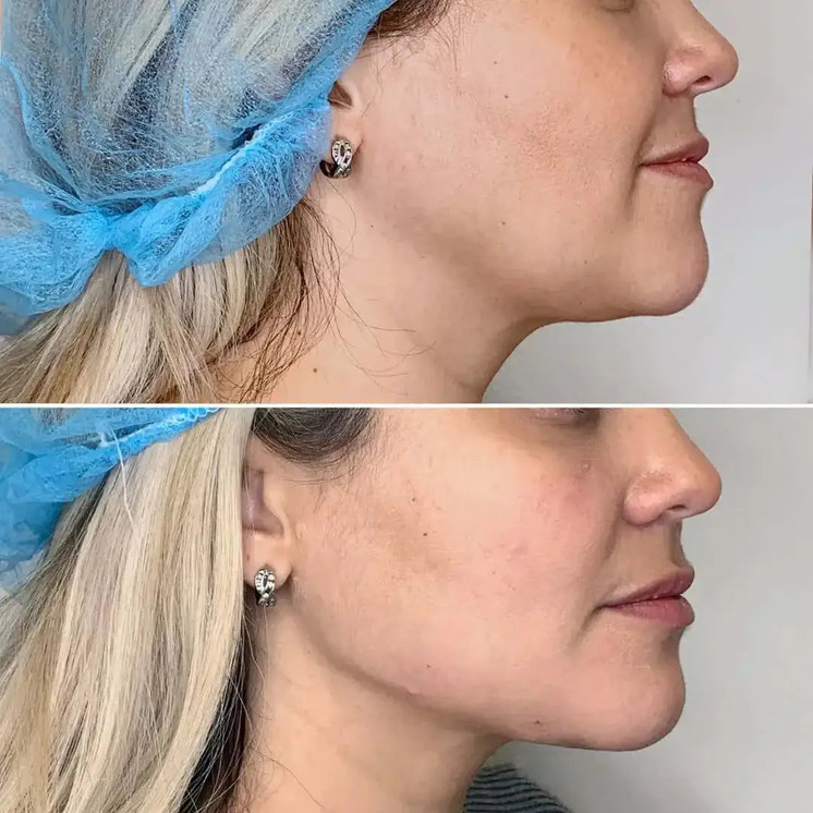 JawlineFix: Filler