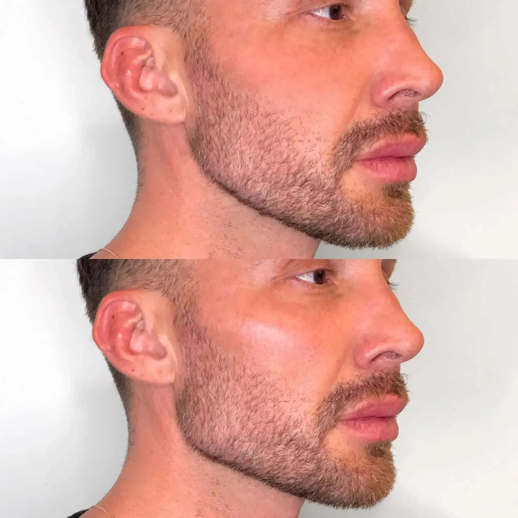 JawlineFix: Filler