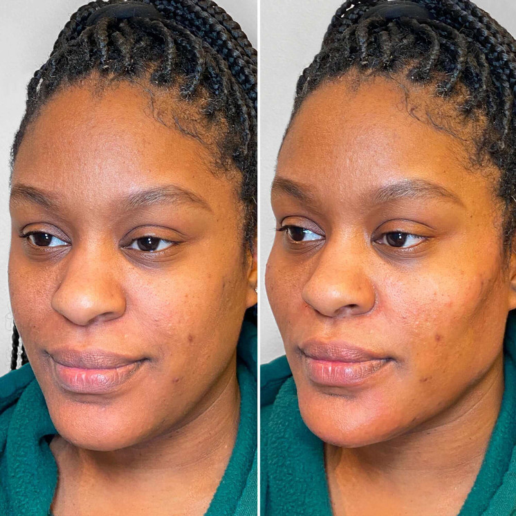 JawlineFix: Filler