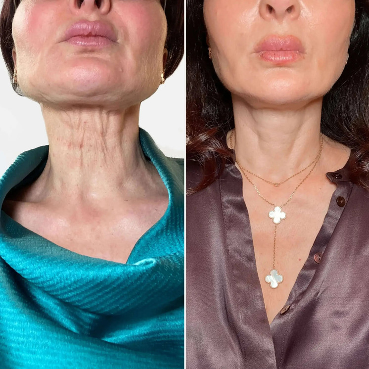 SkinFix: Exosomes