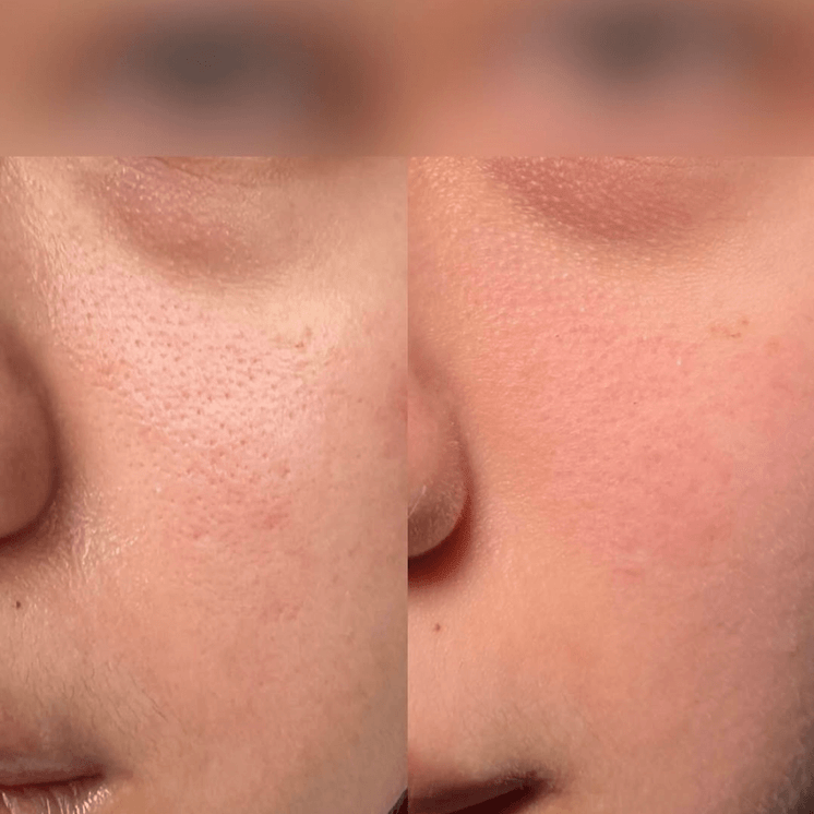 SkinFix: K-Beauty Botox Facial
