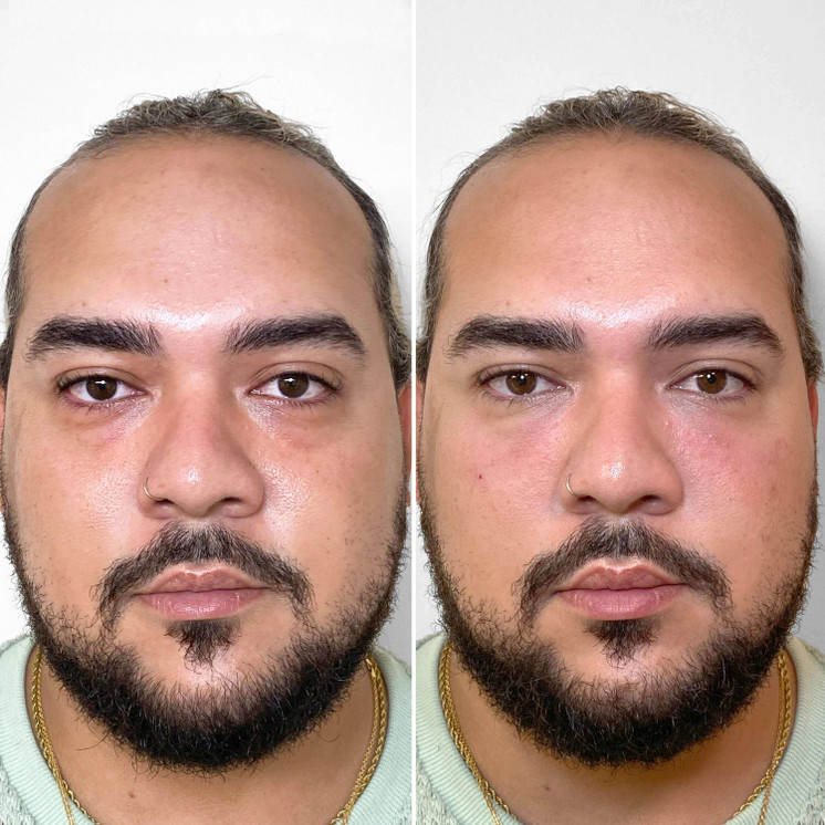 SkinFix: Microneedling + Plasma