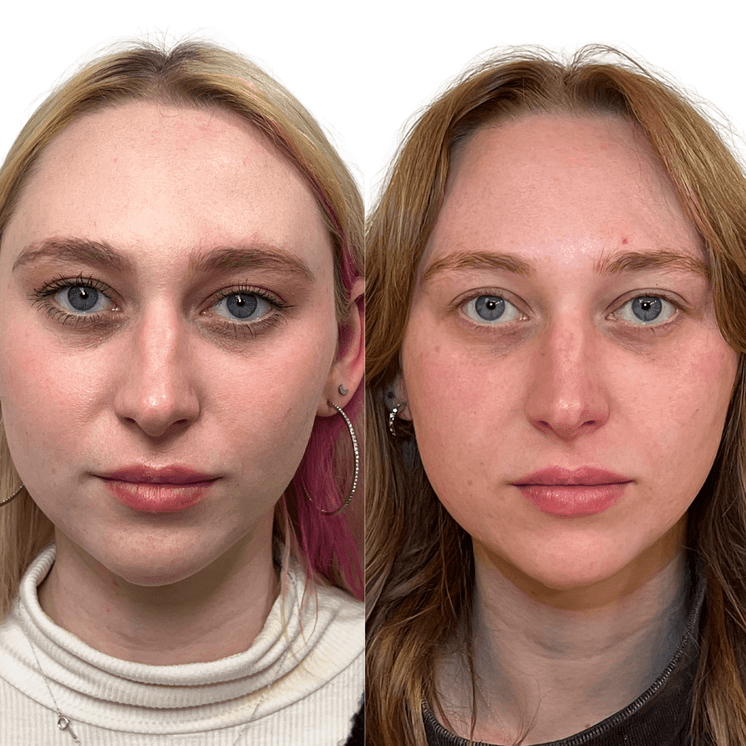 SkinFix: Microneedling + PRF