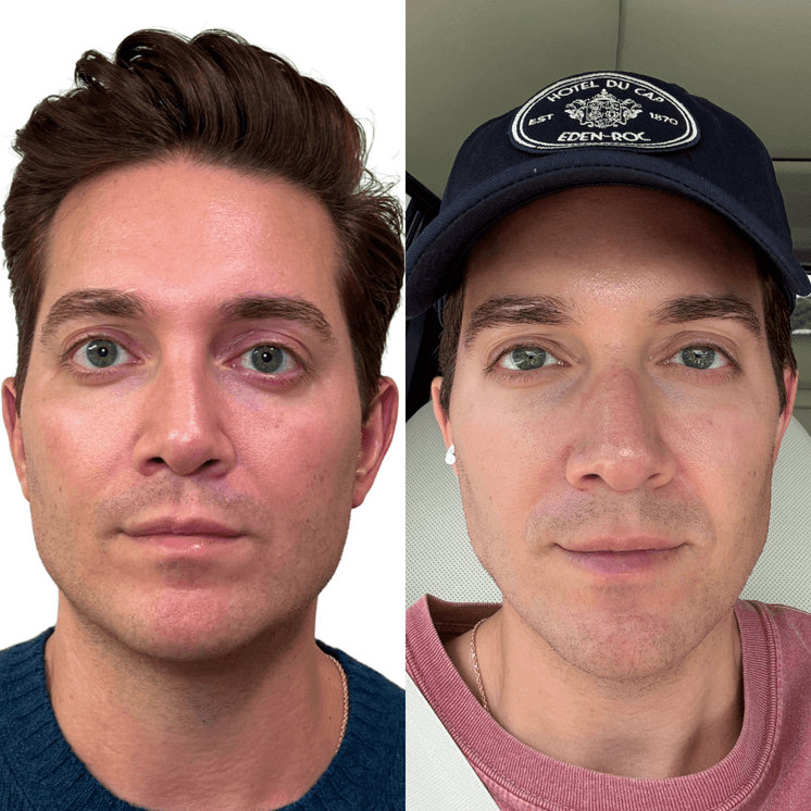 SkinFix: Microneedling + PRF