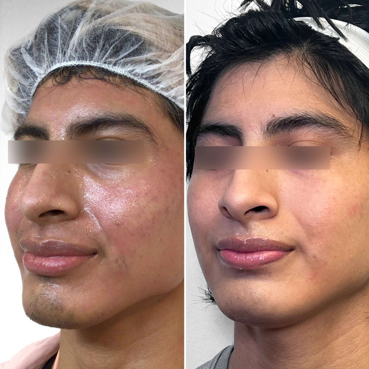 SkinFix: Morpheus8