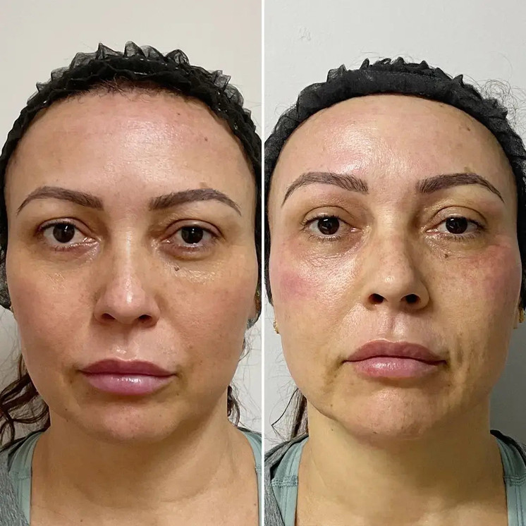 SkinFix: Resurfacing Facial