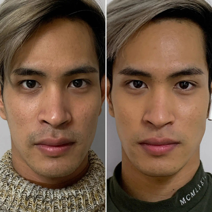 SkinFix: Resurfacing Facial