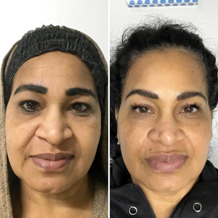 SkinFix: Resurfacing Facial