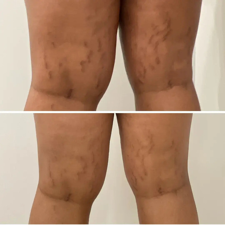SkinFix: Resurfacing Facial