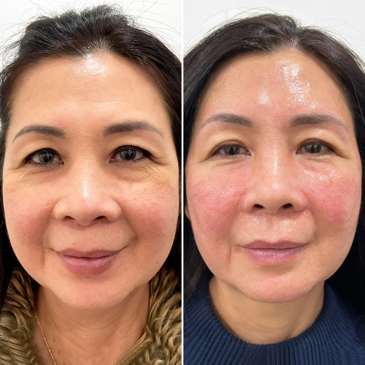 SkinFix: Sculpting Facial