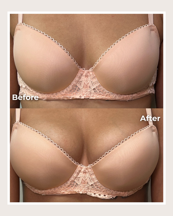 Alloclae® Breast Lift & Enhancement