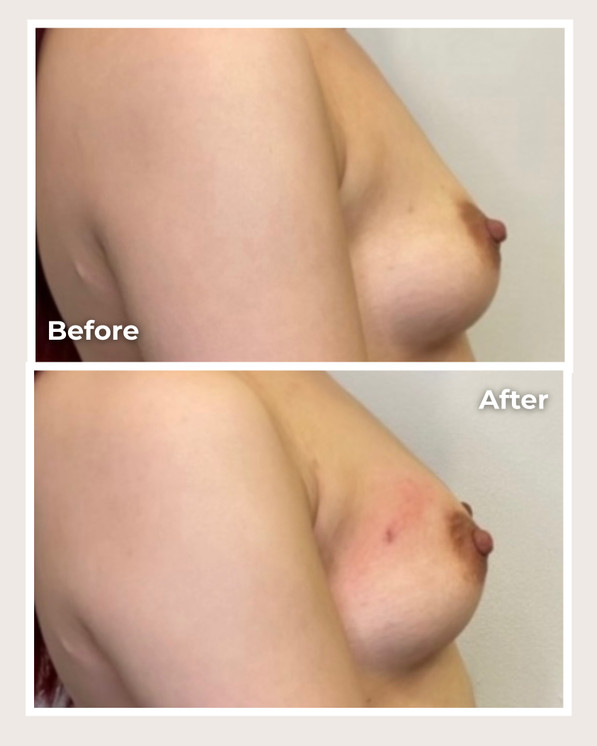 Alloclae® Breast Lift & Enhancement