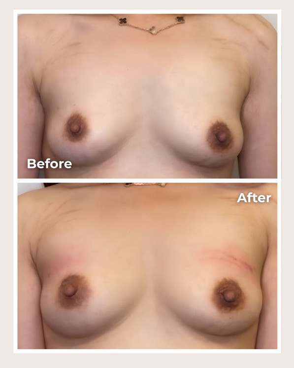 Alloclae® Breast Lift & Enhancement