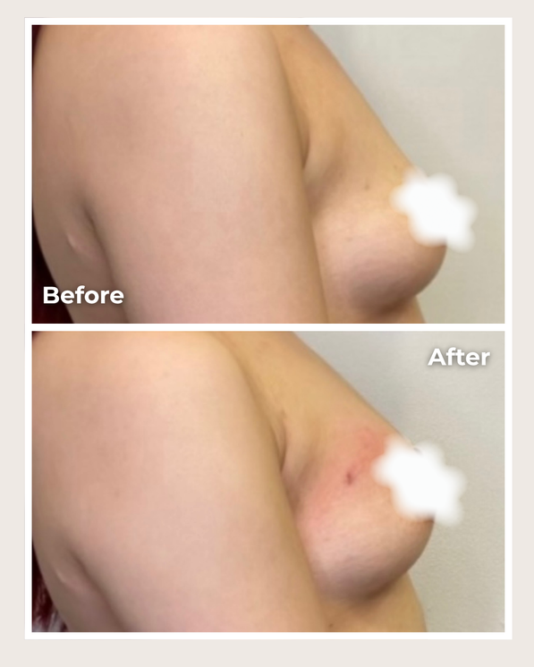 Alloclae® Breast Lift & Enhancement