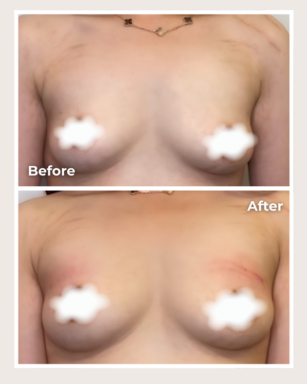 Alloclae® Breast Lift & Enhancement