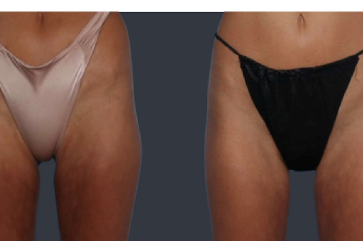 Lipoderma® Fat Restoration