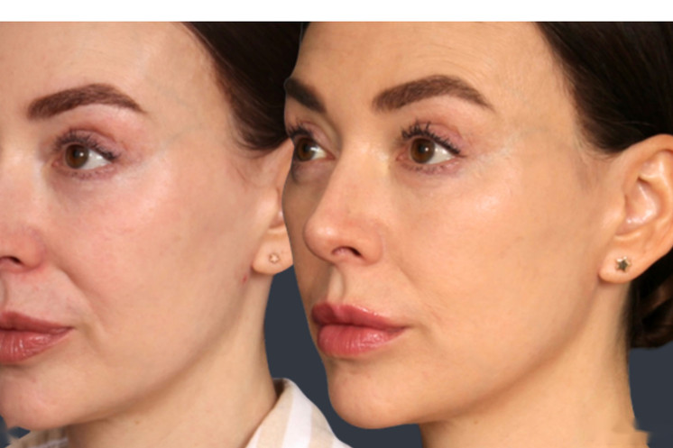 Lipoderma® Fat Restoration