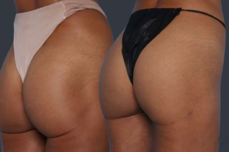 Lipoderma® Fat Restoration