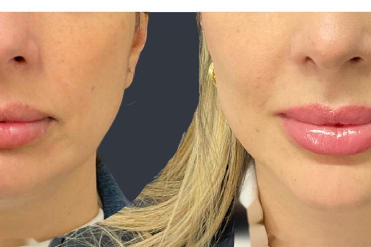Lipoderma® Fat Restoration