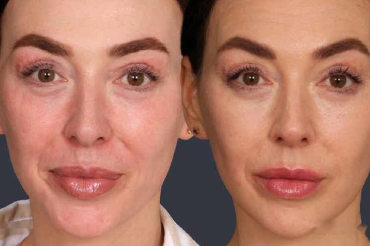 Lipoderma® Fat Restoration