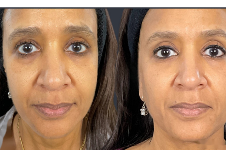 Lipoderma® Fat Restoration
