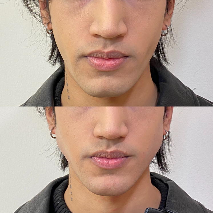 JawlineFix: Filler