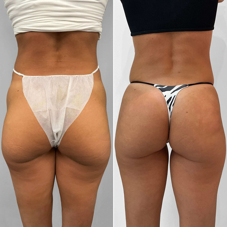 BootyFix: Bio BBL
