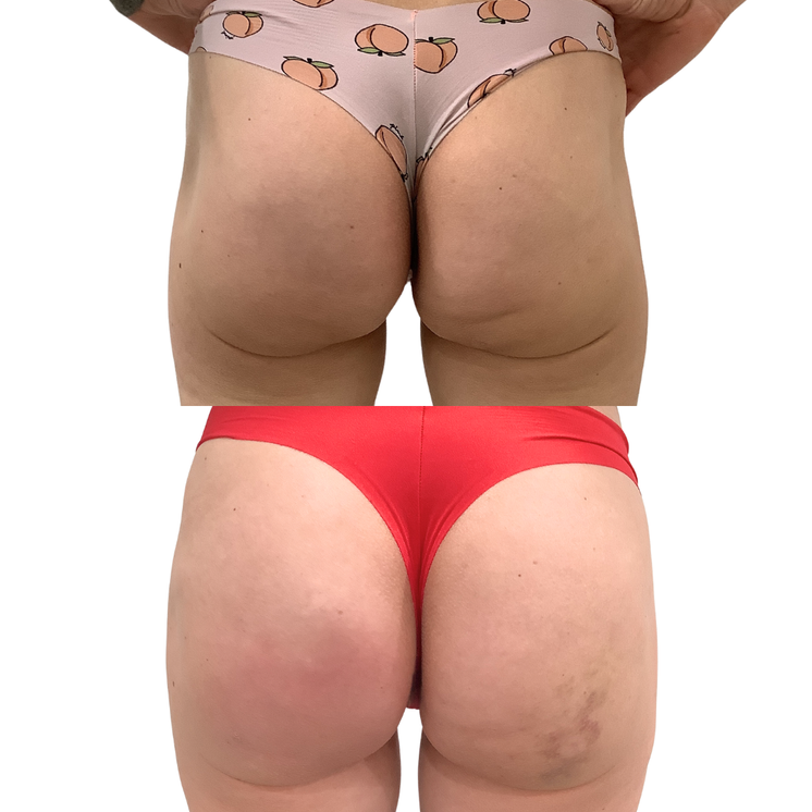 BootyFix: Bio BBL