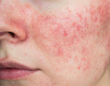 WHAT IS ROSACEA?